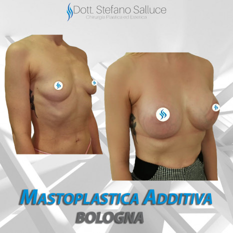 Mastoplastica additiva Dott. Stefano Salluce